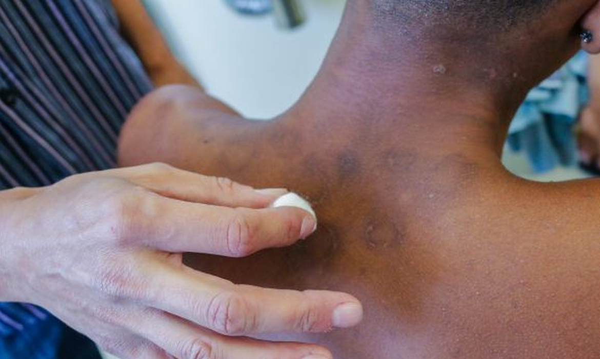 Nova oferta de medicamento traz alternativa para pacientes resistentes