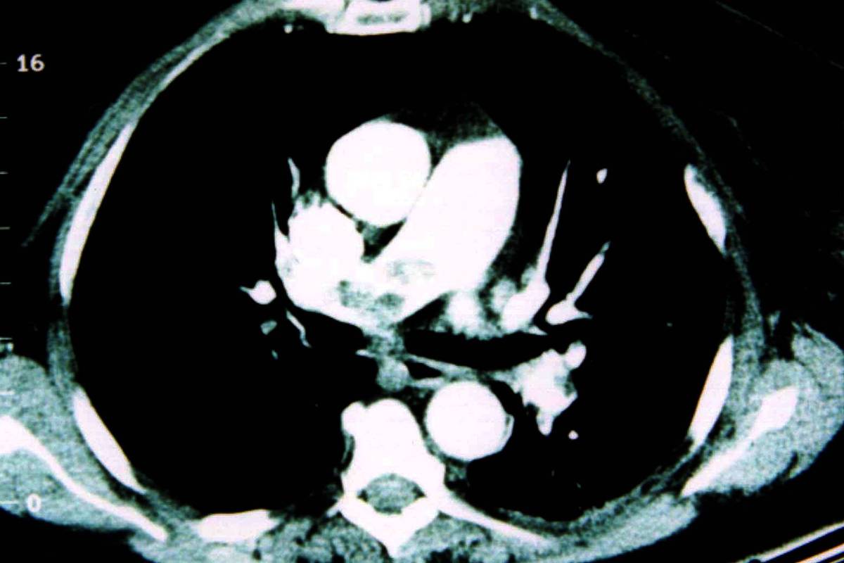 Tratamento após alta hospitalar diminuiu casos de trombose venosa profunda e embolia pulmonar Tratamento após alta hospitalar diminuiu casos de trombose venosa profunda e embolia pulmonar