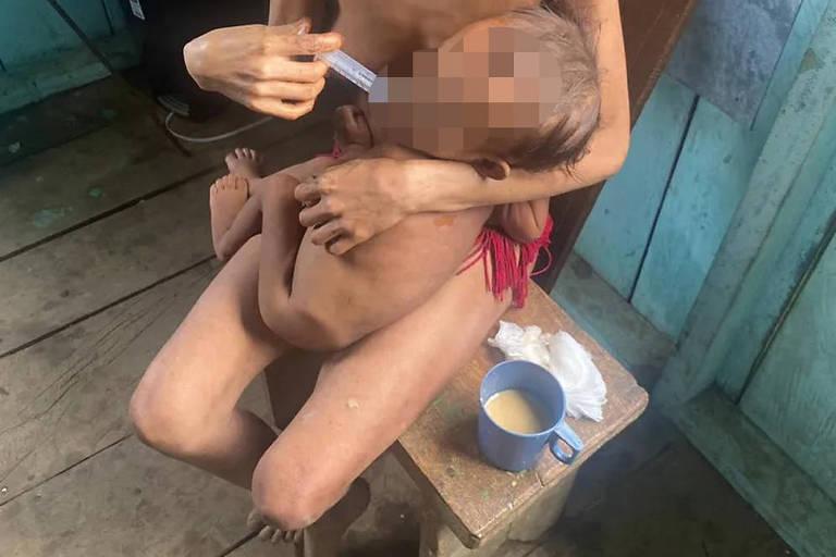 00 Criança yanomami recebe alimentação por meio de seringa em Roraima