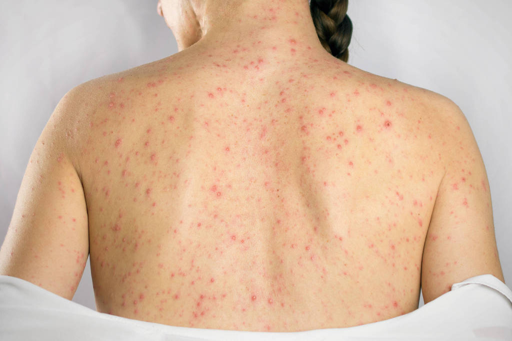 Saúde registrou 122 mil casos no primeiro semestre de 2022, incluindo em gestantes e sífilis congênita