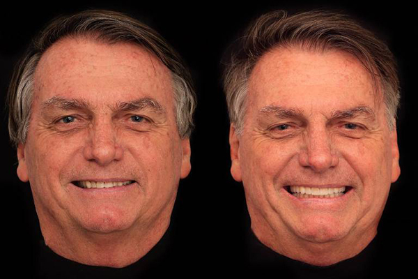 Foto antes e depois de Jair Bolsonaro após procedimento feito em uma clínica de Goiânia